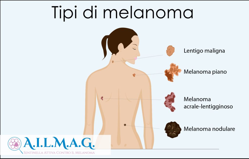 Tipi-di-melanoma