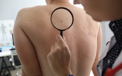 Il melanoma: dalla diagnosi alle nuove frontiere della terapia
