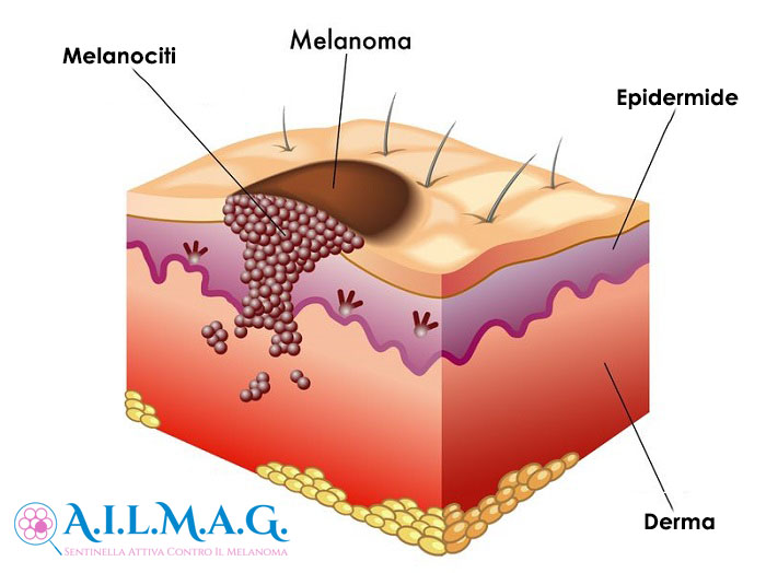 melanoma-stadi